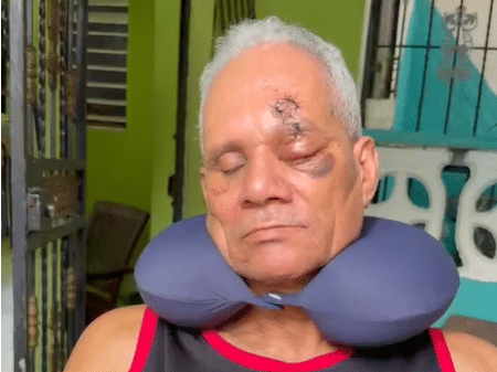 Hombre de 60 años pierde un ojo tras recibir un botellazo durante una agresión en La Guáyiga
